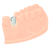 Individuelles Abutment