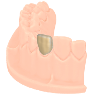 Veneer
