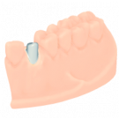 Individuelles Abutment